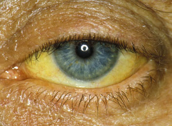 Ignoring Pancreatic Cancer Symptoms