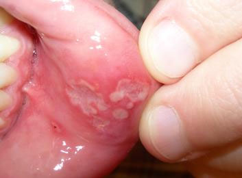 Mouth Ulcers Pancreatic Cancer Symptoms
