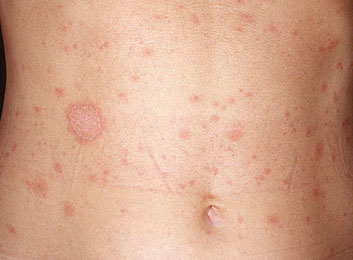 Skin Rash Pancreatic Cancer Symptoms
