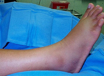 Swelling Pancreatic Cancer Symptoms